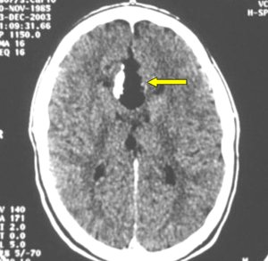 TAC tipica di un lipoma