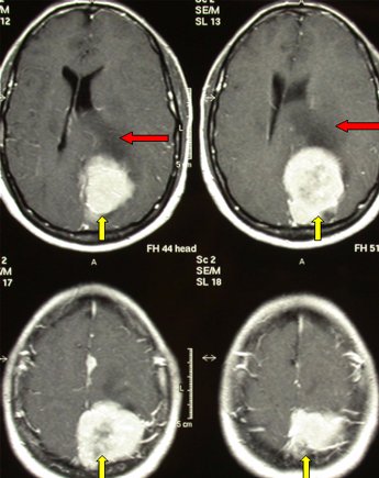 RMN di un meningioma