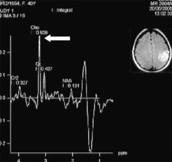 RMN spettroscopica di glioma di basso grado