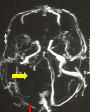 RMN angiografica