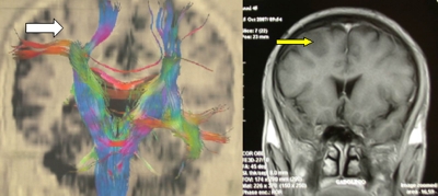 RMN angiografica