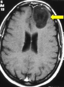 frontal low-grade astrocytoma