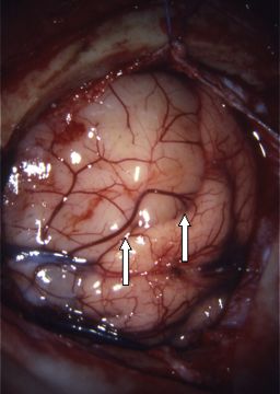 astrocytoma operative view