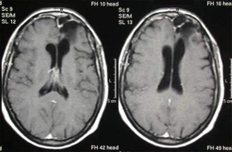 astrocytoma radical surgery