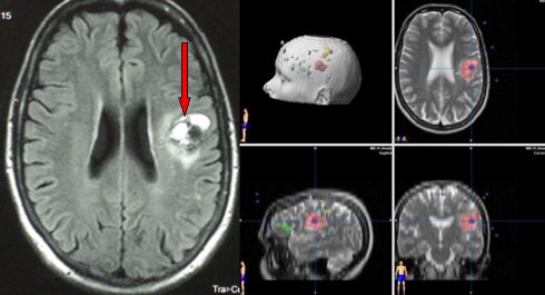 angioma cavernoma