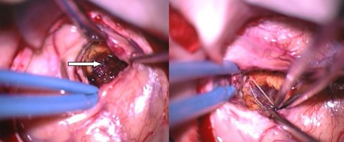 removal of the cavernoma