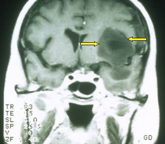 Astrocitoma di basso grado fronto-temporale sinistro