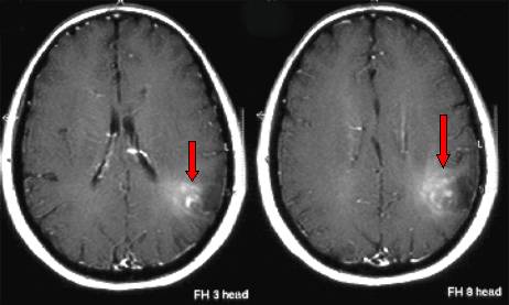 RMN di un oligodendroglioma