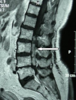 filum terminalis ependymoma