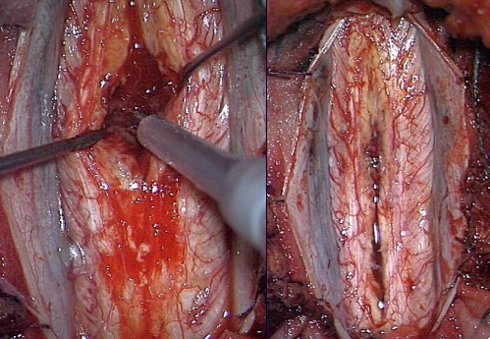 aspetto RMN di un ependimoma intramidollare