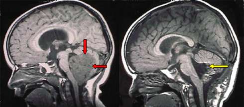 RMN di un medulloblastoma