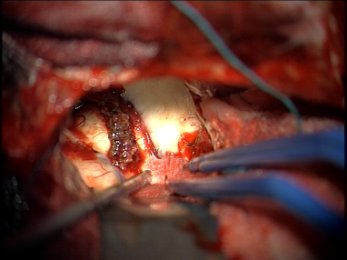 : papilloma del plesso corioideo intraventricolare
