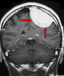 meningioma MRI