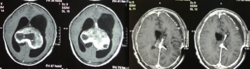 : giant pilocytic astrocytoma