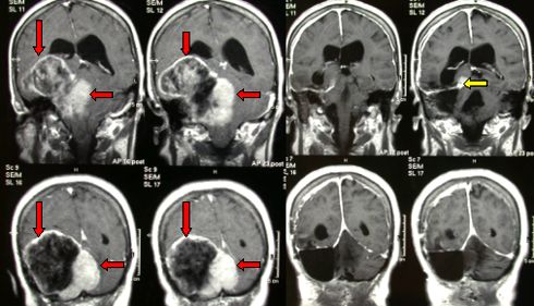 RMN in proiezione frontale di un meningioma