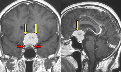 RMN in proiezione frontale e laterale che mostra un meningioma