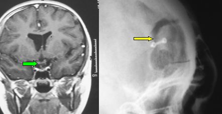 RMN e radiografia asportazione meningioma