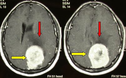 RMN in proiezione assiale di meningioma