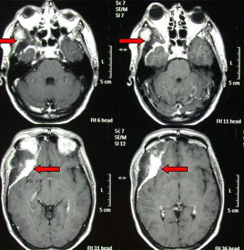 meningioma a placca orbito-sfenoidale destro