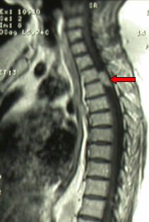 meningioma of the 5th dorsal segment