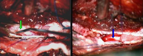 meningioma of the 5th dorsal segment