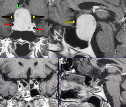 RMN di un adenoma ipofisario gigante