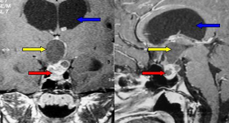 craniopharyngioma