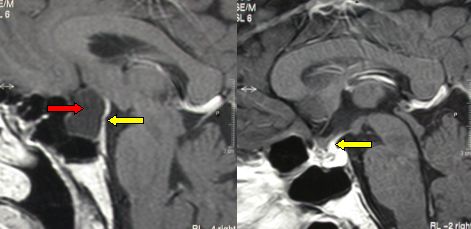 MRI of a Rhatke's cleft cyst