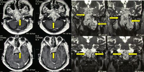 Large cranial base chordoma